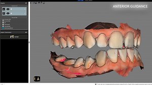 11 reactions | View all bite positions registered with the CS 3600 or CS 3700 intraoral scanner, including maximum intercuspation (MIP), centric relation (CR), left and right canine, and anterior guidance. Learn more: https://www.carestreamdental.com/csscanflow_en | Carestream Dental | Facebook