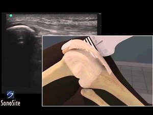 3D Lehrvideo: Ultraschalluntersuchung der Patellasehne -- SonoSite-Ultraschallsysteme