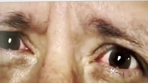 Adult-onset opsoclonus-myoclonus which is rare, striking and always demands a thorough workup. This chaotic eye movement and body jerking combination can be the tip of a neurologic iceberg. The differential diagnosis includes paraneoplastic syndromes and think about lung, breast, ovarian cancers and don't forget anti-Ri or anti-Hu antibodies. Always think about neuroblastoma. Also keep in mind autoimmune encephalitis (NMDA receptor, GAD65), post-infectious causes (especially West Nile or Epstein