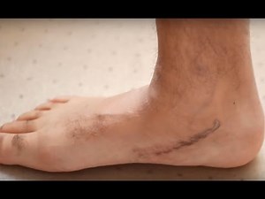 1 Year Update After My Flat Foot Reconstruction Surgery