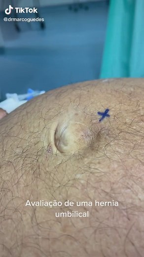 Understanding Umbilical Hernias: Surgery and Types Explained