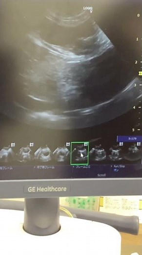 腎臓の結石のチェック(水腎症、エコー検査)