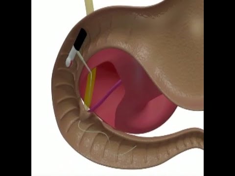 #EUS guided #Biliary #Rendezvous Procedure