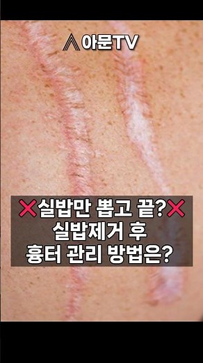 실밥 제거 후 흉터 관리, 어떻게 해야하나요?(성형외과 상처 흉터 수술 봉합 스테리스트립 메피폼 흉터레이저 햇빛 자외선 관리)[아문TV]