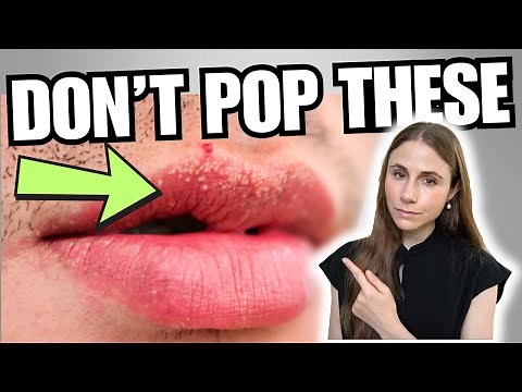 Fordyce Spots: What No One Tells You About Those White Bumps