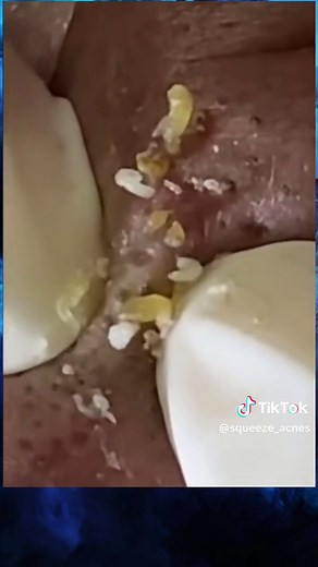 Squeeze_acne no TikTok