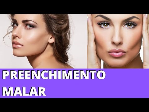 PREENCHIMENTO MALAR: Veja o Antes e Depois