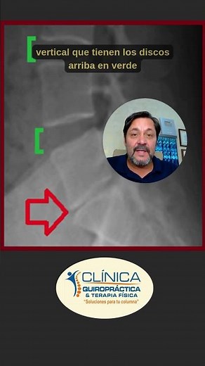 Lumbar X-ray of a Patient Reveals Disc Disease at L5/S1 Level