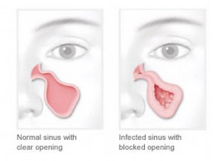 Balloon Sinuplasty - ENT Florida