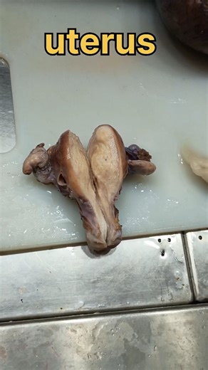 Histo Museum on Instagram: "uterus specimen cutting and fixation| #histologylab #pathologylab #histopathology #museum #ovariancyst #blood #fibroiduterus #cyst #uterusesbeforeduderuses #uterusfibriods #uterusprolapse #fibroiduterus #fibroiduterusremoval #fibroiduterustreatment #fibrocysticbreastdisease #uerus #uteruscancer"