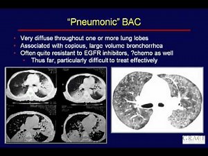 GRACEcast-009_Lung-Cancer_The ABC's of BAC