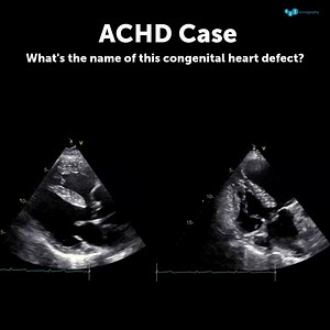Today, we are looking for a congenital cardiac disease characterized by four distinct anatomical abnormalities: 👉 Ventricular septal defect (VSD): A “hole” between the right and left ventricles, leading to abnormal blood flow. 👉 Pulmonary stenosis: Narrowing of the pulmonary valve or pulmonary artery, obstructing blood flow to the lungs. 👉 Right ventricular hypertrophy: Thickening of the right ventricular wall due to increased workload. 👉 Overriding aorta: The aorta is positioned above the V