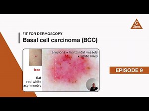 Fit for Dermoscopy Episode 9 – Basal Cell Carcinoma