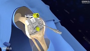 Gemini SL Operation Technique with the Perseus Smart Cutting Guide