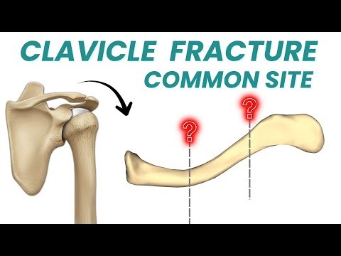 What's the common site of CLAVICLE FRACTURE and WHY?