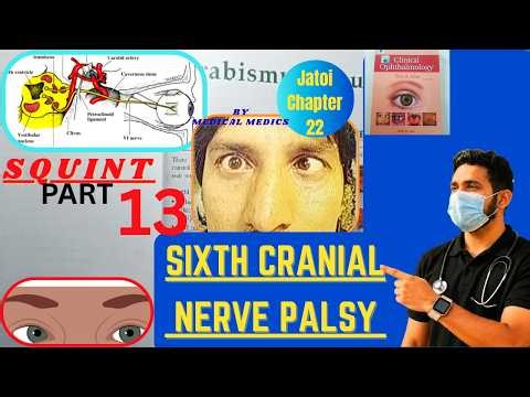 Sixth Cranial Nerve Palsy | Squint | Jatoi Clinical Ophthalmology Chapter 22 Part 13