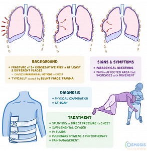 Flail Chest: What Is It, Causes, Symptoms, and More | Osmosis