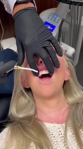 Many of you have been asking about the process for vampire fangs! #howto #fyp #dentist #viral