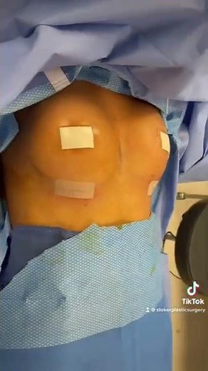 BREAST AUGMENTATION BEFORE AND AFTER - Incredible Results!