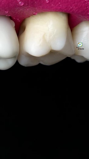 𝙈𝙤𝙡𝙖𝙧 𝙩𝙚𝙚𝙩𝙝 𝙚𝙭𝙩𝙧𝙖𝙘𝙩𝙞𝙤𝙣🦷🧑‍⚕️ #dr_of_smile #i_love_dentistry❤ #foryou #foryoupage #video #viral #trending #dentist #tiktok #viralvideo #viraltiktok #grow #account #tiktokpakistan #unfrezzmyaccount