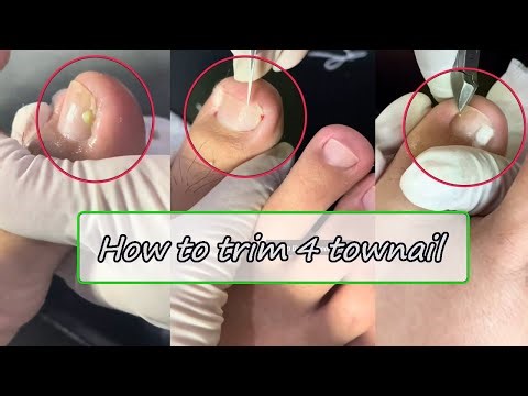 Infected Toenail Trimming & Cuticle Removal - SO SATISFYING