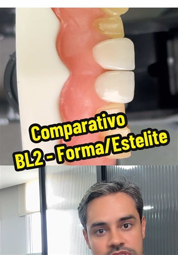 Diferença entre Facetas de Resina BL2 Estelite e Forma
