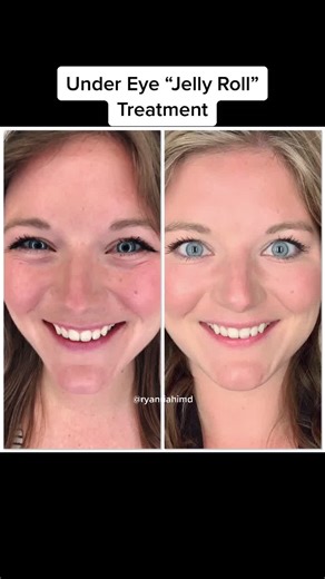 Jelly Roll Botox Treatment #botox #botoxcheck #undereyecircles #undereyebags #undereyetreatment #dysport #dermatologist #dermatology #undereyes