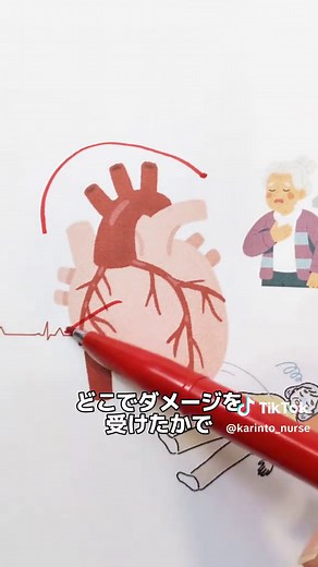 冠動脈と看護の関係を分かりやすく解説