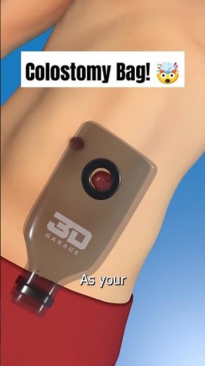 Colostomy Bag Explained! 🏥💡