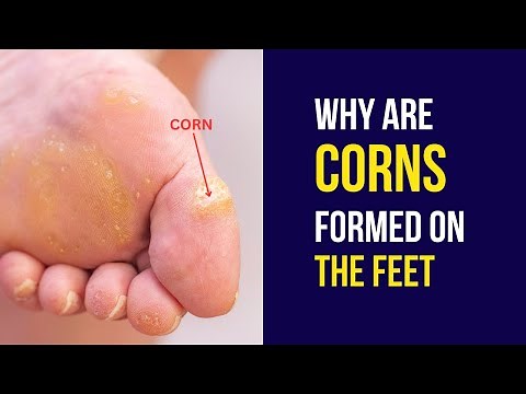 Why Are Corns Formed on the Feet