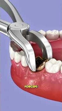 How Tooth extraction procedure is performed? #ToothExtraction