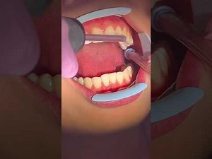 How To bond Invisalign clear aligner attachments with an attachment template