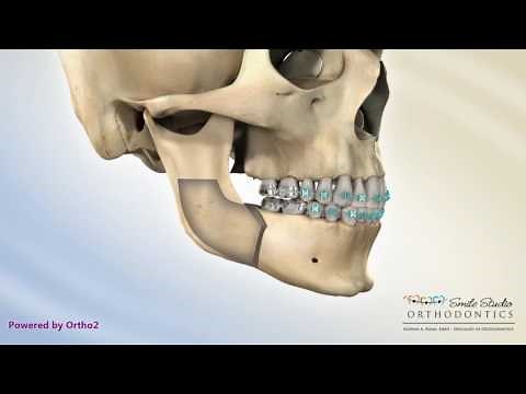 BSSO Mandibular Setback - Transcortical
