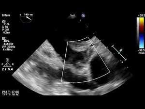 TEE: Left atrial appendage thrombus