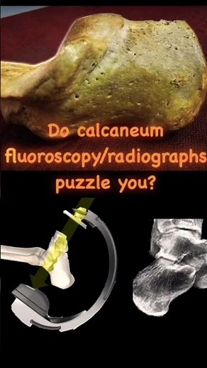 Understand Basics of Calcaneum Fluoroscopy/Radiographs #ortho #trauma #surgeon