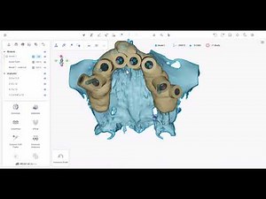 Master Bone-Supported Guide Design with Atomica: From Planning to Printing!