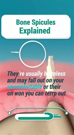 🦷 Feeling a Sharp Bone After a Tooth Extraction?