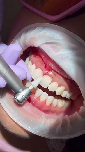 Dentist fixes front tooth gap. #toothgap #dentist #gaptooth