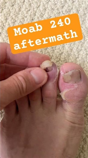 Moab 240 toenail blister