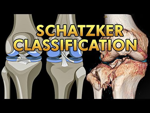 Schatzker Classification of Tibial Plateau Fractures