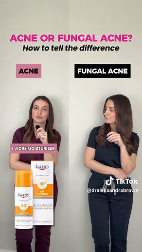 Struggling with breakouts that just won’t go away? You might actually be fighting the wrong type of “acne.” Tender, red pimples that respond well to salicylic acid, benzoyl peroxide, and retinoids are typical acne. But those tiny, uniform, itchy bumps on your forehead, chest, or back? That’s often fungal acne, and standard acne products won’t clear them. For these stubborn bumps, targeted antifungal washes and creams are the key to finally clearing your skin. Here’s how to tell the difference so