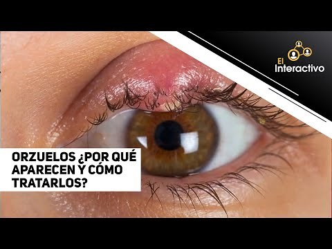 Orzuelos ¿Por qué aparecen y cómo tratarlos?