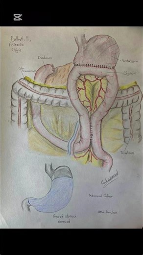Gastric resection Billroth type II