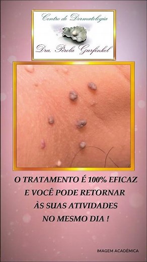 SABE O QUE SÃO ESTAS "VERRUGAS"? #dermatologia