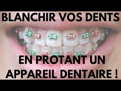 Comment Blanchir Vos Dents en Portant Un Appareil Dentaire ?