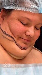 You Won’t Believe How Dramatically Her Look Changed After This Simple Surgery... Results in Comments 👇👇👇 | Beautiful World