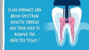 An Alternative to Standard Root Canal Treatment