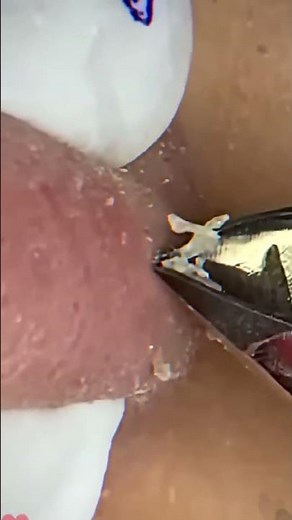 Skincare ｜ Blackheads Removal #tweezer #skincare #blackheads 10