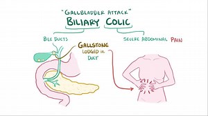 Video: Biliary colic - Video Explanation! | Osmosis | Osmosis