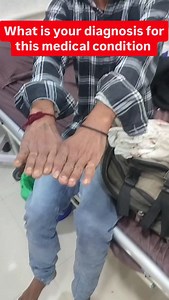 Alcoholic withdrawal Symptoms that occur when someone stops using alcohol after a period of heavy drinking. Symptoms of alcohol withdrawal can vary widely in severity. In severe cases, the condition can be life-threatening. Symptoms may occur from two hours to four days after stopping alcohol. They may include headaches, nausea, tremors, anxiety, hallucinations and seizures. Treatment consists of medication like Benzodiazepines to control the symptoms and vitamin supplements to help with nutriti